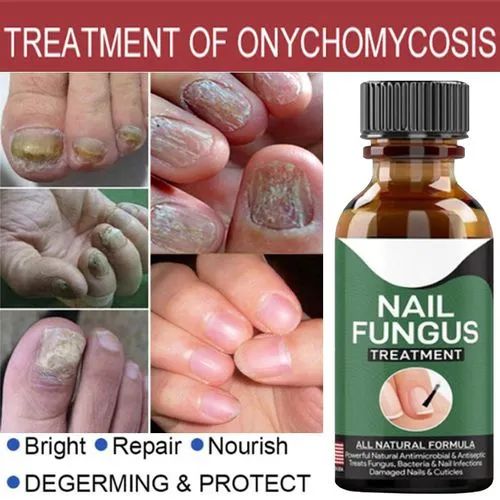 Fast Nail Fungus Treatment – Nail Repair Essence & Anti-Fungal Gel for Healthy, Clear Nails