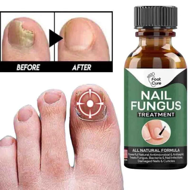Fast Nail Fungus Treatment – Nail Repair Essence & Anti-Fungal Gel for Healthy, Clear Nails